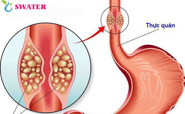 Nước nóng quá có thể gây ung thư
